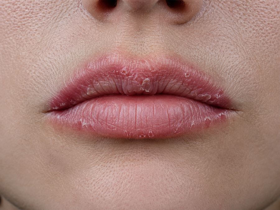 Labios agrietados y resecos, con piel descamada tras usar un plumper convencional
